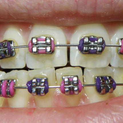 Invisible Braces are the Alternative to Visible Braces