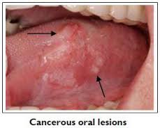 cancerous oral lesions