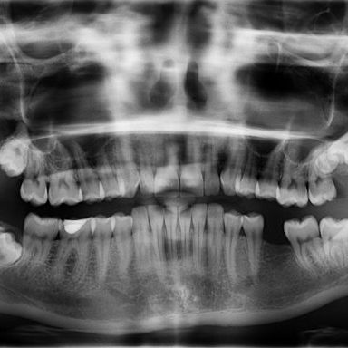What to Do with Broken, Chipped or Missing Teeth