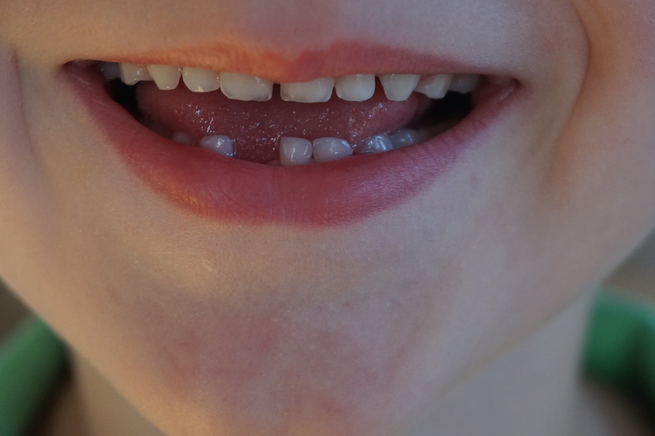 When Do Children Get Permanent Teeth?