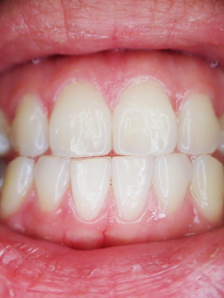 Gum Diseases And Issues Experienced With The Gums Vitality Dental