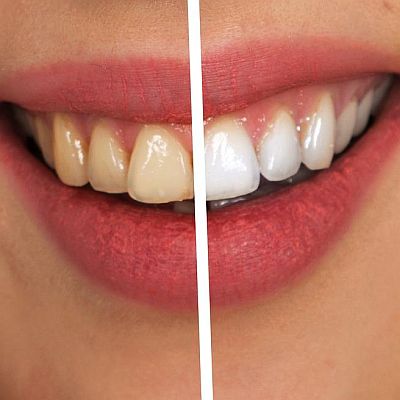 Get a brighter smile this autumn with our teeth whitening offer in West Sussex!