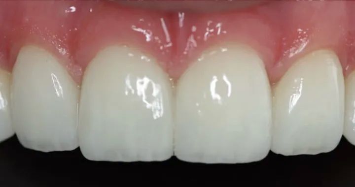 Teeth with veneers for comparison